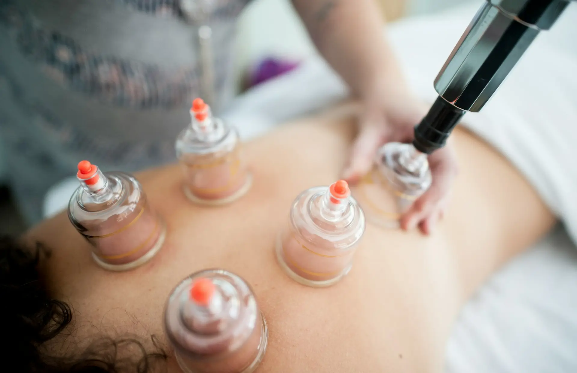 ragazza massaggia con coppettazione